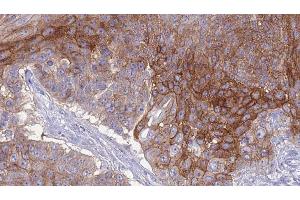 ABIN6276827 at 1/100 staining Human urothelial cancer tissue by IHC-P. (CEACAM1 抗体  (C-Term))
