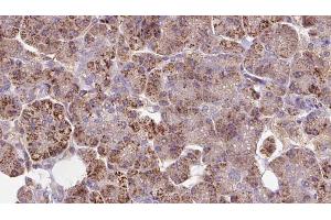ABIN6273283 at 1/100 staining Human pancreas cancer tissue by IHC-P. (LEPREL2 抗体  (Internal Region))