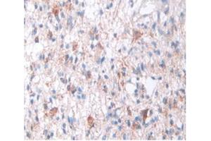 IHC-P analysis of Human Glioma Tissue, with DAB staining. (SOD2 抗体  (AA 25-222))