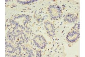 Immunohistochemistry of paraffin-embedded human breast cancer using ABIN7147264 at dilution of 1:100 (RAD17 抗体  (AA 1-270))