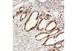 Immunohistochemical analysis of ERK3 staining in human breast cancer formalin fixed paraffin embedded tissue section. (MAPK6 抗体)