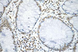 Immunohistochemistry was performed on paraffin-embedded human sigmoid colon carcinoma using histone H3 (acetyl K9) antibody (ABIN7798953), 1:200). (Recombinant Histone 3 抗体  (H3K9ac))