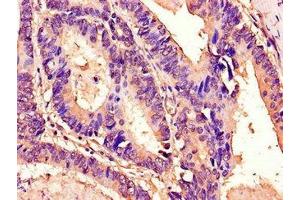 Immunohistochemistry of paraffin-embedded human colon cancer using ABIN7172930 at dilution of 1:100 (Tetraspanin 7 抗体  (AA 114-184))