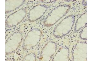 Immunohistochemistry of paraffin-embedded human colon cancer using ABIN7142126 at dilution of 1:100 (DPH2 抗体  (AA 1-489))
