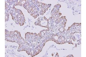 IHC-P Image Immunohistochemical analysis of paraffin-embedded human lung cancer, using FOXRED1, antibody at 1:300 dilution. (FOXRED1 抗体)