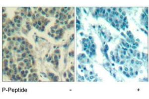 Immunohistochemical analysis of paraffin-embedded human breast carcinoma tissue using ERBB3 (phospho Y1328) polyclonal antibody . (ERBB3 抗体  (pTyr1328))