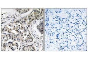 Immunohistochemistry analysis of paraffin-embedded human breast carcinoma tissue using USP6NL antibody. (USP6NL 抗体  (Internal Region))