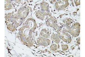 Immunohistochemistry of paraffin-embedded human breast cancer using GAPDH antibody. (GAPDH 抗体  (AA 1-335))