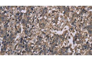 Immunohistochemistry of paraffin-embedded Human liver cancer tissue using MCC Polyclonal Antibody at dilution 1:30 (MCC 抗体)