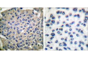 P-peptide - +Immunohistochemical analysis of paraffin-embedded human breast carcinoma tissue using Cortactin (phospho-Tyr466) antibody. (Cortactin 抗体  (pTyr466))