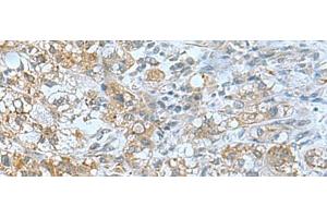 Immunohistochemistry of paraffin-embedded Human liver cancer tissue using TSGA10 Polyclonal Antibody at dilution of 1:50(x200) (TSGA10 抗体)