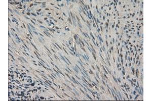 Immunohistochemical staining of paraffin-embedded Carcinoma of kidney tissue using anti-SLC18A2 mouse monoclonal antibody. (SLC18A2 抗体)