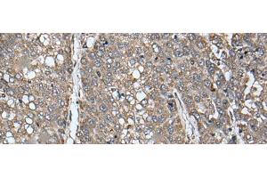 Immunohistochemistry of paraffin-embedded Human liver cancer tissue using ATAD1 Polyclonal Antibody at dilution of 1:65(x200) (ATAD1 抗体)