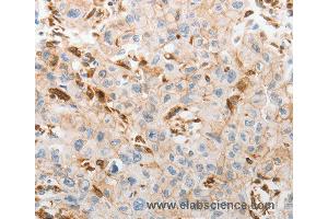 Immunohistochemistry of Human lung cancer using SLC15A2 Polyclonal Antibody at dilution of 1:60 (SLC15A2 抗体)