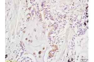 Formalin-fixed and paraffin embedded human lung carcinoma labeled with Rabbit Anti ARHGAP24 Polyclonal Antibody, Unconjugated  at 1:200 followed by conjugation to the secondary antibody and DAB staining (ARHGAP24 抗体  (AA 501-600))