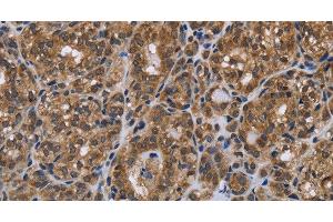 Immunohistochemistry of paraffin-embedded Human thyroid cancer using GALK1 Polyclonal Antibody at dilution of 1:40 (GALK1 抗体)