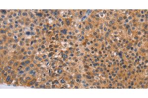 Immunohistochemistry of paraffin-embedded Human liver cancer tissue using NIF3L1 Polyclonal Antibody at dilution 1:30 (NIF3L1 抗体)