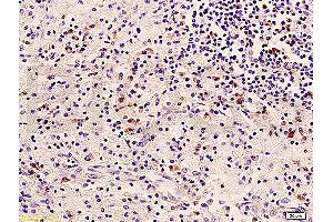 Formalin-fixed and paraffin embedded human cervical carcinoma labeled with Anti-HER2/NEU/ErbB2 Polyclonal Antibody, Unconjugated (ABIN725345) at 1:400 followed by conjugation to the secondary antibody and DAB staining (ErbB2/Her2 抗体  (AA 1210-1255))