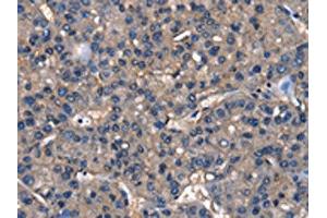The image on the left is immunohistochemistry of paraffin-embedded Human liver cancer tissue using ABIN7129820(IGFBP5 Antibody) at dilution 1/25, on the right is treated with fusion protein. (IGFBP5 抗体)