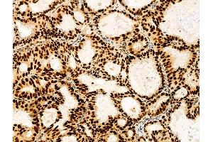 ABIN7094292 and ABIN7098339 at 1/100 staining Human lung cancer by IHC-P. (HTATSF1 抗体  (C-Term))