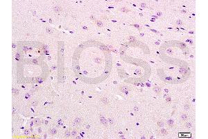 Formalin-fixed and paraffin embedded human bladder carcinoma labeled with Anti-IL12RB2 Polyclonal Antibody, Unconjugated (ABIN747878) at 1:200 followed by conjugation to the secondary antibody and DAB staining (IL12RB2 抗体  (AA 301-400))