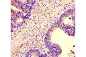 Immunohistochemistry of paraffin-embedded human ovarian cancer using ABIN7161242 at dilution of 1:100 (NBEAL2 抗体  (AA 1360-1574))