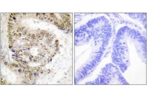 Immunohistochemistry analysis of paraffin-embedded human colon carcinoma tissue, using hnRNP L Antibody. (HNRNPL 抗体  (AA 61-110))