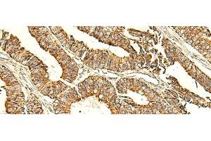 Immunohistochemistry of paraffin-embedded Human colorectal cancer tissue using ATP5PD Polyclonal Antibody at dilution of 1:50(x200) (ATP5H 抗体)
