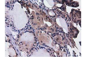 Immunohistochemical staining of paraffin-embedded Adenocarcinoma of Human ovary tissue using anti-CBWD1 mouse monoclonal antibody. (CBWD1 抗体)