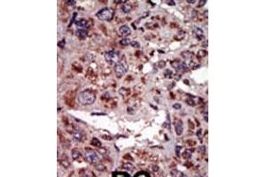 Formalin-fixed and paraffin-embedded human cancer tissue reacted with the primary antibody, which was peroxidase-conjugated to the secondary antibody, followed by AEC staining. (DGKA 抗体  (C-Term))