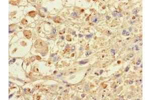 Immunohistochemistry of paraffin-embedded human melanoma using ABIN7146024 at dilution of 1:100 (SPAG9 抗体  (N-Term))