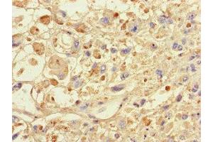 Immunohistochemistry of paraffin-embedded human melanoma using ABIN7146024 at dilution of 1:100 (SPAG9 抗体  (N-Term))