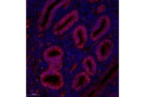 Immunofluorescence analysis of paraffin embedded human endometrial cancer using GDF5 (ABIN7074131) at dilution of 1: 200 (GDF5 抗体)