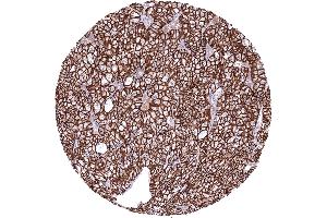 Kidney Chromophobe renal cell carcinoma with strong CDH16 immunostaining of tumor cells CDH16 immunohistochemistry (Recombinant Cadherin-16 抗体)