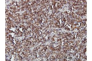 Immunoperoxidase of monoclonal antibody to SLC44A2 on formalin-fixed paraffin-embedded human lymphoma. (SLC44A2 抗体  (AA 123-230))