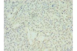 Immunohistochemistry of paraffin-embedded human breast cancer using ABIN7170902 at dilution of 1:100 (SDHC 抗体  (AA 30-62))
