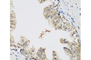 Immunohistochemistry of paraffin-embedded Human prostate using RRM1 Polyclonal Antibody at dilution of 1:200 (40x lens). (RRM1 抗体)