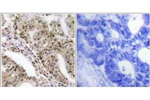 Immunohistochemistry analysis of paraffin-embedded human lung carcinoma, using AS160 (Phospho-Thr642) Antibody. (TBC1D4 抗体  (pThr642))