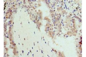 Immunohistochemistry of paraffin-embedded human lung cancer using ABIN7145816 at dilution of 1:100 (BRD7 抗体  (AA 601-651))