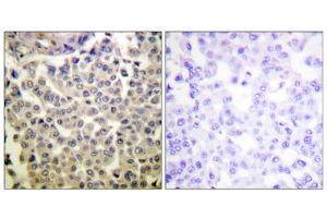 Immunohistochemistry analysis of paraffin-embedded human breast carcinoma tissue using PAK1/2/3 (Phospho-Thr423/402/421) antibody. (PAK1/2/3 抗体  (pThr402, pThr421, pThr423))