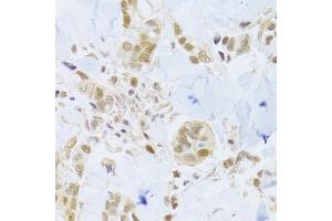 Immunohistochemistry of paraffin-embedded human breast cancer using MCM4 Antibody (ABIN5971548) at dilution of 1/100 (40x lens). (MCM4 抗体)
