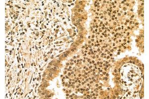 ABIN6265880 and ABIN6277188 at 1/100 staining Human prostate cancer by IHC-P.