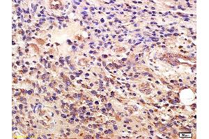 Formalin-fixed and paraffin embedded human glioma labeled with Anti-GLI1/ZFP5 Polyclonal Antibody, Unconjugated (ABIN673374) at 1:200 followed by conjugation to the secondary antibody and DAB staining. (GLI1 抗体  (AA 601-700))