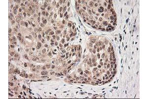 Immunohistochemical staining of paraffin-embedded Adenocarcinoma of Human breast tissue using anti-MGLL mouse monoclonal antibody. (MGLL 抗体)