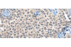 Immunohistochemistry of paraffin-embedded Human ovarian cancer tissue using CLTCL1 Polyclonal Antibody at dilution of 1:60(x200) (CLTCL1 抗体)