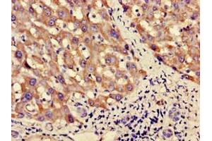 Immunohistochemistry of paraffin-embedded human liver cancer using ABIN7162571 at dilution of 1:100 (PNLIPRP3 抗体  (AA 201-467))