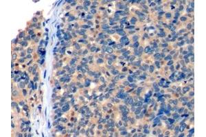 Detection of ICOSLG in Human Ovarian cancer Tissue using Polyclonal Antibody to Inducible T-Cell Co Stimulator Ligand (ICOSLG)