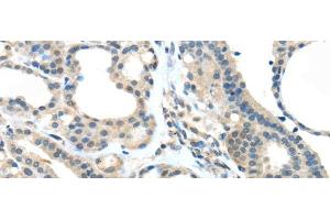 Immunohistochemistry of paraffin-embedded Human thyroid cancer tissue using VSIG10 Polyclonal Antibody at dilution 1:45 (VSIG10 抗体)