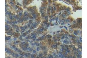 Detection of MMP7 in Human Thyroid cancer Tissue using Polyclonal Antibody to Matrix Metalloproteinase 7 (MMP7) (MMP7 抗体  (AA 1-267))