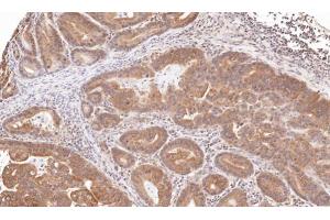 IHC-P Image Immunohistochemical analysis of paraffin-embedded human gastric cancer, using TRIM23, antibody at 1:100 dilution. (TRIM23 抗体  (N-Term))